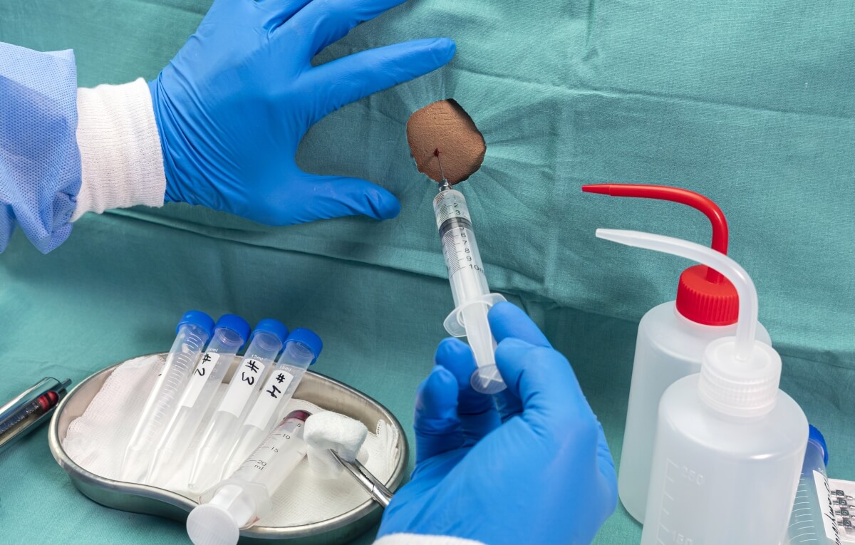 Ręce w rękawiczkach przygotowują narzędzia do wykonania biopsji.